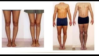 How To Straighten Bow Legs How To Correct Knock Knees Knock Knees Surgery Fix Bow Legs [upl. by Ardnauq330]