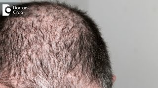 Minoxidil for hair loss  Dr K Prapanna Arya [upl. by Ivon842]