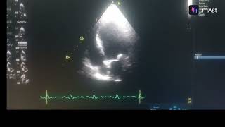 HYPOKINESIA OF ANTERO SEPTUM APICAL SEPTUM AND APEX MODERATE TO SEVERE LV MILD MR [upl. by Assirral]