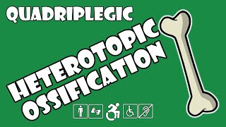 Heterotopic Ossification HO Explained  Quadriplegic C5C6C7 [upl. by Ydnagrub]