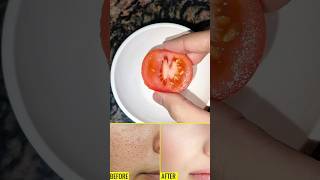 🔥open pores home remedy openpores skincare skincaretips ytshorts viralshorts viral shorts [upl. by Power]