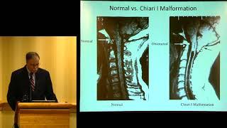 quotSyringomyelia Update Diagnosis Treatment and Researchquot  John D Heiss MD [upl. by Lrig]