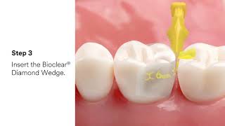 3M™ Filtek™ Dental Restoratives and Bioclear® [upl. by Byrne]