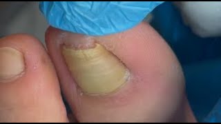 Super deformed naills treatment [upl. by Earlene]