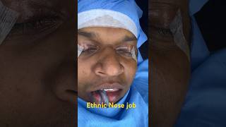 Ethnic thick skinned broad South Indian Dravidian esthetic nose face plastic surgery rhinoplasty [upl. by Ellehcal]