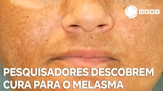 Pesquisadores descobrem cura para o melasma [upl. by Medorra]