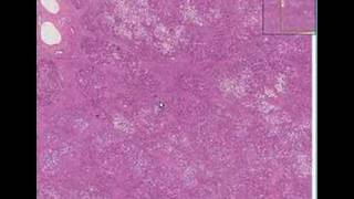 Histopathology LiverCirrhosis micronodular [upl. by Magena]