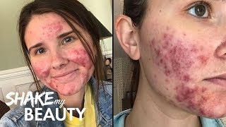 Going Out With My Severe Acne For The First Time  SHAKE MY BEAUTY [upl. by Machute75]