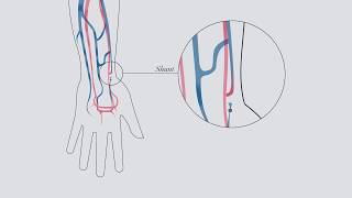 Understanding hemodialysis [upl. by Nehepts287]