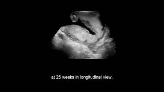 Placental Abnormalities vasa previa morbidly adherent placenta placental abruption [upl. by Field]