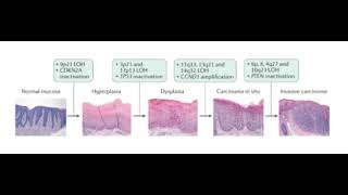 Progression of Squamous cell Carcinoma [upl. by Leinto]