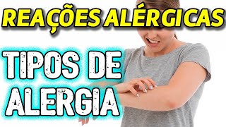 Reações Alérgicas  Diferentes tipos de alergia [upl. by Goodrich110]