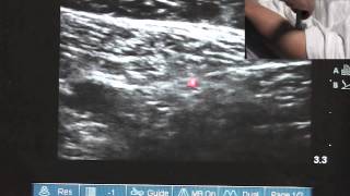 Ultrasound Guided Saphenous Nerve Block  SSRAUSAcom [upl. by Noda822]