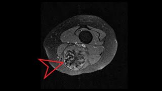 Knee MRI Knee Mass Tumor [upl. by Reyaht]