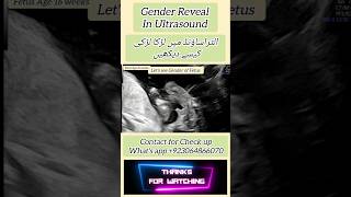 Gender in Ultrasound 16 weeks [upl. by Zulch]