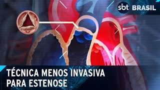 SUS oferece técnica menos invasiva para o tratamento de estenose aórtica  SBT Brasil 170424 [upl. by Warrin]