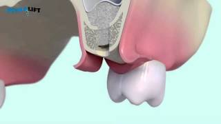 IntraLift® 3D by SATELEC® ACTEON® YouTube [upl. by Leddy]