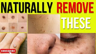 HOW TO NATURALLY REMOVE SKIN TAGS BLACKHEADSWARTSAGEING SPOTS AND MOLES AT HOMEhomeremedies [upl. by Ahsilam]