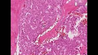 Histopathology OvaryGranulosa cell tumor [upl. by Anairda]