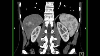 Abdomen Liver Cavernous Hemangioma of the Liver2 of 9 [upl. by Narik]