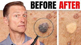 How to Remove Skin Tags and Warts Overnight  Dr Berg Explains [upl. by Rumery]