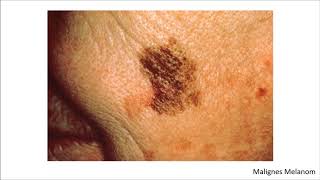 Dermatologie Blickdiagnosen  Krankheitsbilder [upl. by Melvyn721]