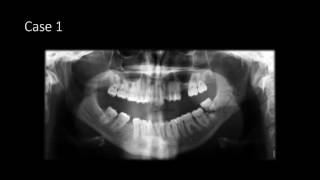 Mandible Fractures on Panoramic Radiographs [upl. by Airet]