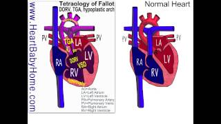 Heart Defect 29 Tetralogy of Fallot TGA DORV VSD hypoplastic arch [upl. by Xenia967]