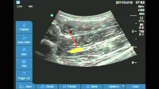 Ultrasound guided anterior sciatic nerve block [upl. by Zanlog]