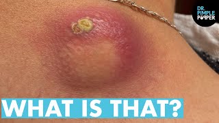 WHAT IS THAT Dr Lee Pops Satisfying Back Cyst  Dr Pimple Popper Reacts [upl. by Ailehpo187]