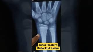 What is Torus Fracture Distal End RadiusDr Sai Chandra [upl. by Mulcahy]