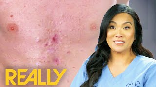 Dr Lee Pops Over 40 Pimples From Patients Chest  Dr Pimple Popper Pop Ups [upl. by Eioj]