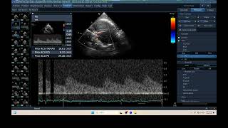 IQ 307 TCD BRAIN CPP ICP ECHOPAC ANALYSIS ULTRASOUND HWD 2 [upl. by Chamberlin]