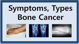 Bone Cancer Symptoms and Types [upl. by Nennarb525]