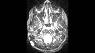 Intracranial Hypotension [upl. by Eelahc]