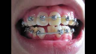 Braces  Before and After Time Lapse [upl. by Shien]