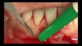 10 Bilaminar technique on single incisor in the lower jaw [upl. by Ybbor377]