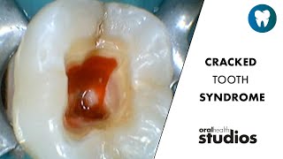 Cracked Tooth Syndrome – A Spectrum of Treatment Choices  Weekly Wisdom 🦷 [upl. by Demah]