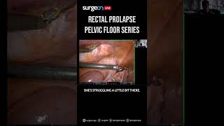 Second Episode of the Pelvic Floor Series Rectal Prolapse [upl. by Ynotna]