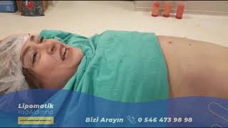 Lipomatik  Liposuction  Yağ Aldırma [upl. by Tammany]