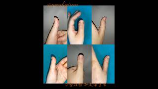 Brachydactyly Type D distraction lengthening brachydactyly doctor thumb meganfox [upl. by Stevenson]