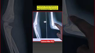 Paediatric Elbow Fracture XRay Findings xray shorts [upl. by Seraphina]