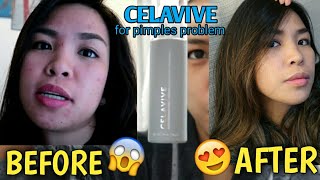 My first Skincare Routine using USANA Celavive for 60days Goodbye AcnePimples [upl. by Eisnyl]