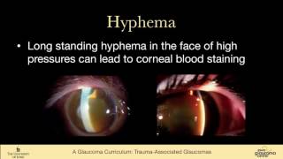 26 SECONDARY GLAUCOMAS Trauma associated Glaucomas Angle Recession hyphema Ghost Cell Siderosis [upl. by Aynatal]