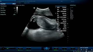 Achondroplasia ultrasound findings Diagnostic ultrasound cases [upl. by Ymor]