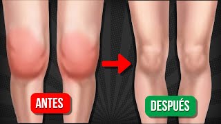 5 EJERCICIOS para DESINFLAMAR LA RODILLA y eliminar el LÃQUIDO [upl. by Nevla]