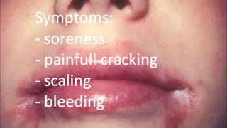 Angular Cheilitis Treatment permanent  How to Cure Angular Cheilitis in 12 hours [upl. by Primalia]