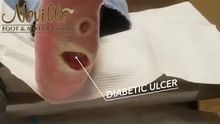 Diabetic Ulcer Wound Care PART 1 [upl. by Eugaet]