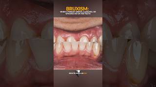 The Best Small TeethBruxism Solution [upl. by Jew]