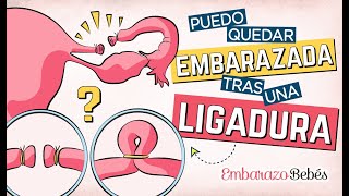 Con una LIGADURA de TROMPAS ✂️😯 ¿Puedo Quedar EMBARAZADA  Embarazo y Bebés [upl. by Susana]